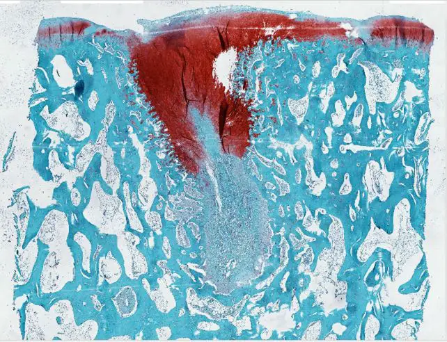 A treated cartilage wound, with the healed section stained red/Samuel I. Stupp/Northwestern University
